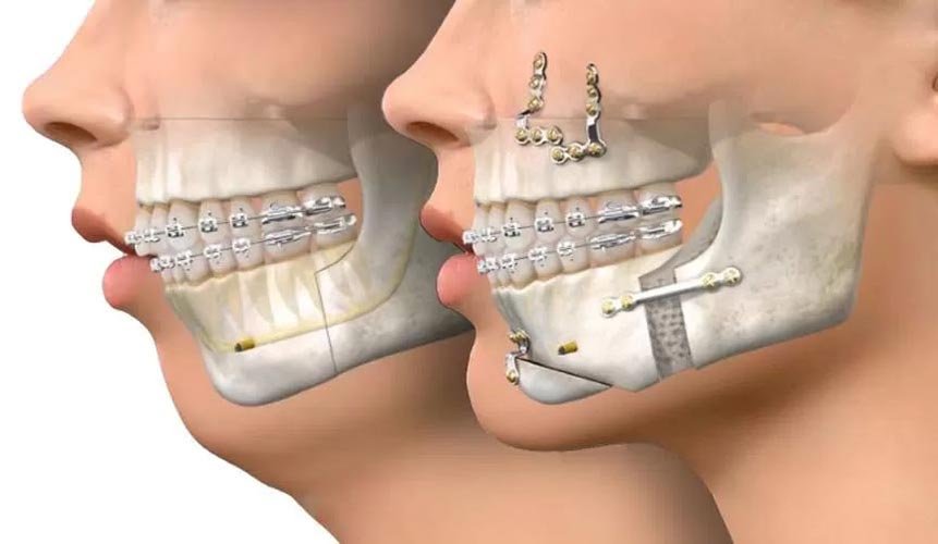 cirurgia ortognática