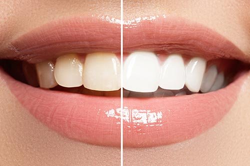 clareamento dentário