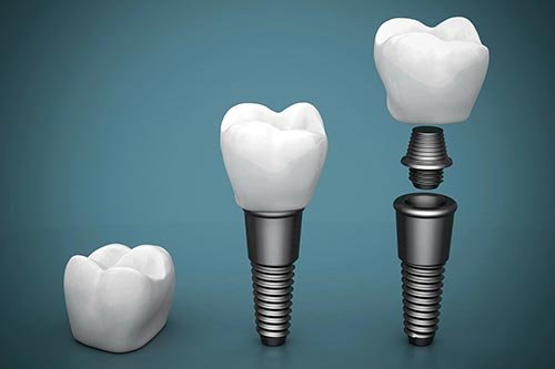 implantes dentários