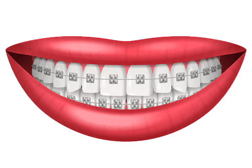 sorriso com aparelho