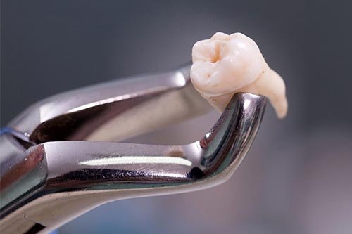 triar o dente do siso